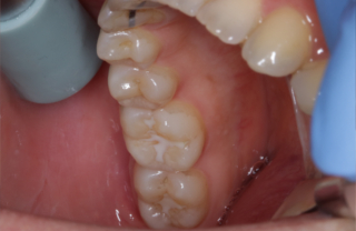Durch eine Neigung des Patientenkopfes sind alle Flächen der Unterkieferzähne instrumentierbar