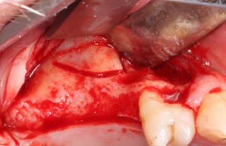 Praeparation des Knochendeckels mit der Ultraschallsäge