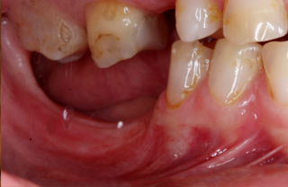 Zahnimplantate - eine Lösung für jedes Alter